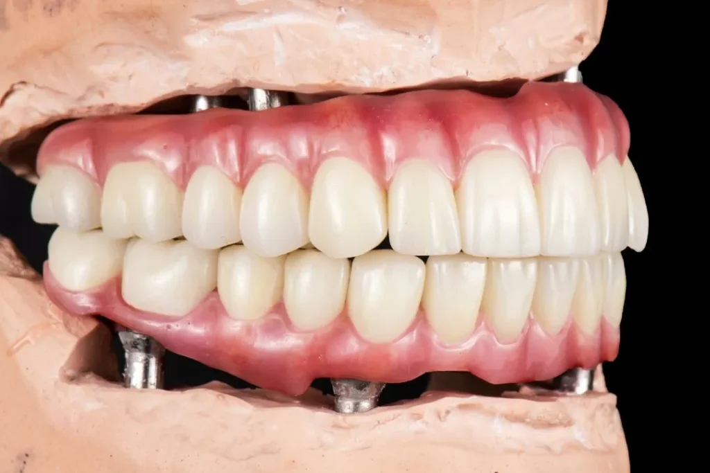How to Choose the Best Dental Clinic in Jaipur for Dental Implants: A Practical Guide
