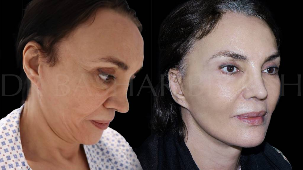 Is a Facelift in Dubai the Right Way to Refresh Your Appearance?